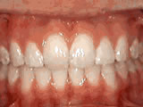 overbite-after